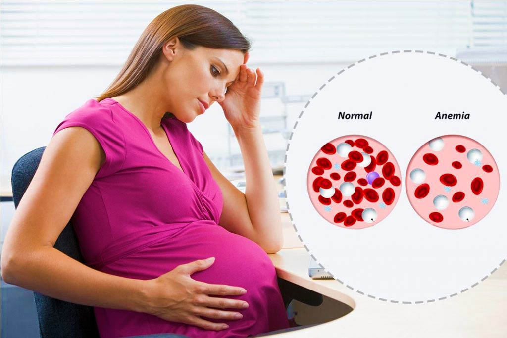 Як проявляється анемія у вагітних